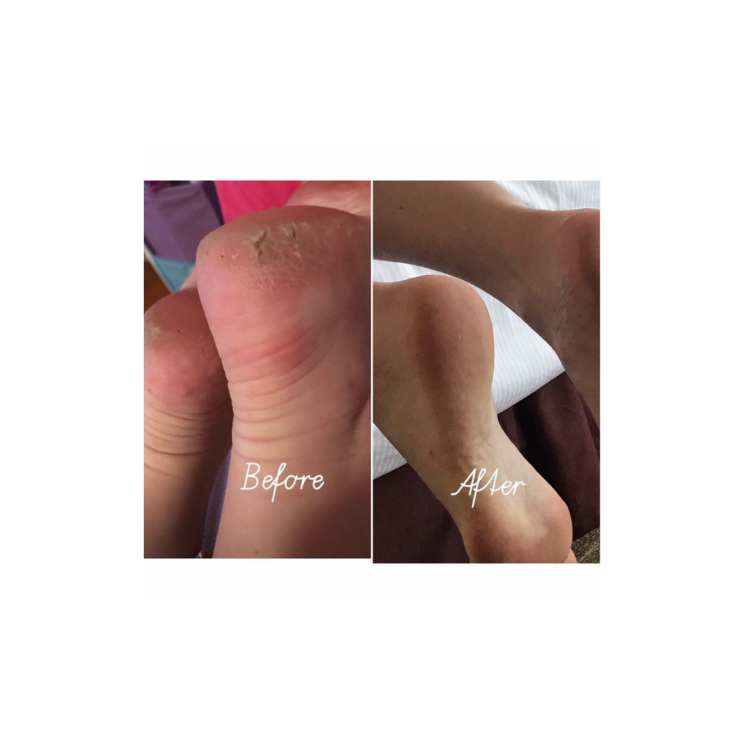 Before & After picture of Casey Peeler's feet using epoch Sole Solution